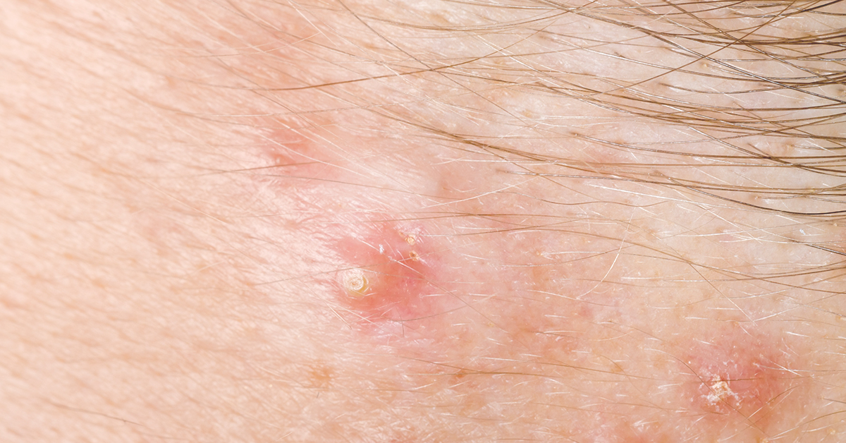 How to Care for Hidradenitis Suppurativa Wounds Tips and Techniques