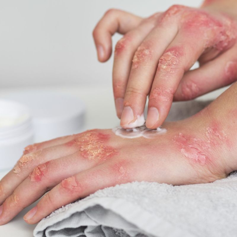 Eczema Relief